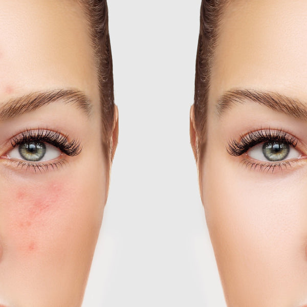 The Do and Don’t on problematic skin teen and adult breakout