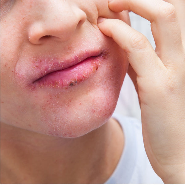 Using Sang ‘s Balm Collection for Eczema, Dry Itchy  Skin